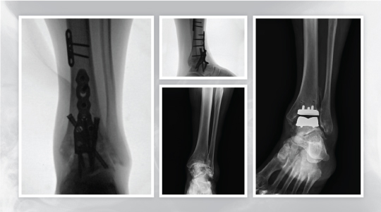 Ankle Replacement — Ankle Arthritis, Ankle Replacement, Arthrodesis