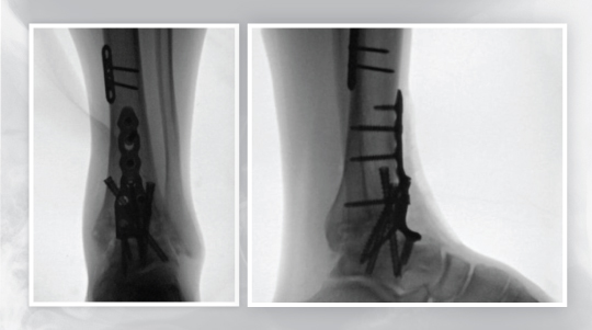 Ankle fusion at UOA