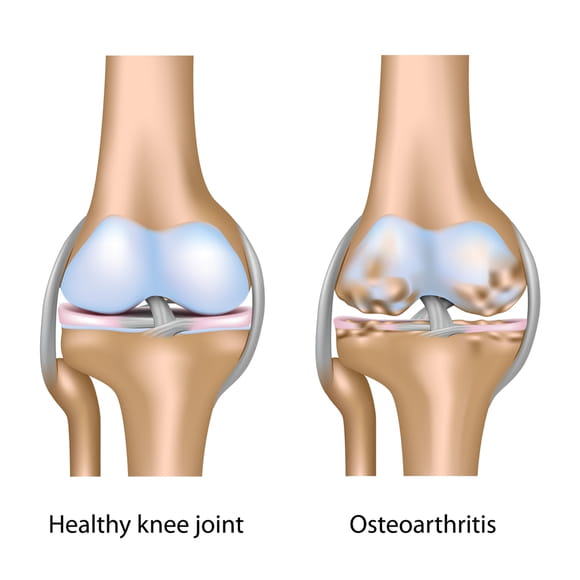 Healthy knee vs osteoarthritis