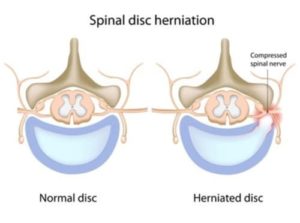 Herniated disc illustration