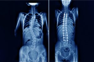 Scoliosis before and after