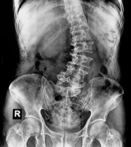 X-ray of a spine with scoliosis