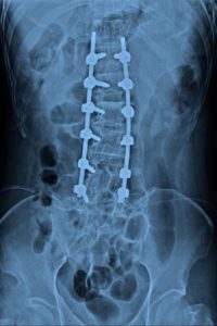 Scoliosis hardware