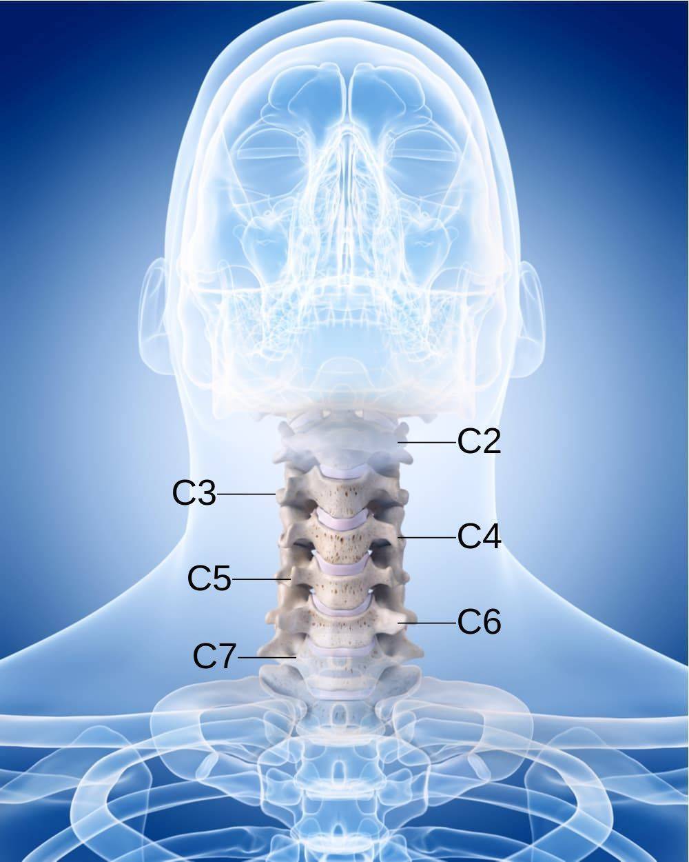 Cervical Spine Fusion C3-C5 ACDF